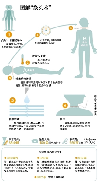 世界首例人體換頭術(shù)